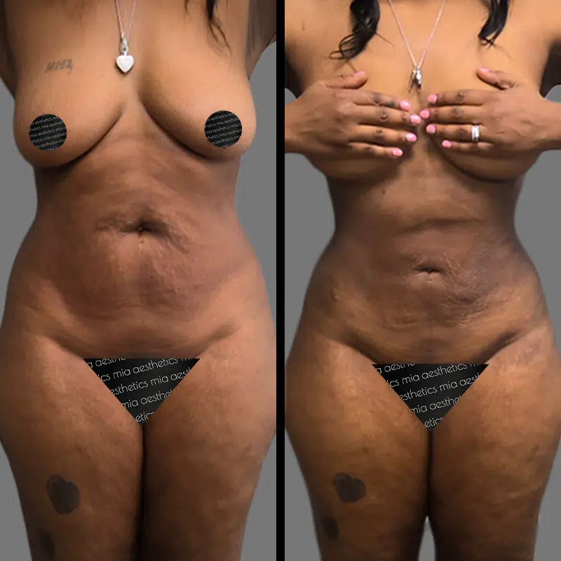 Dr. Rozentsvit Lipo 360 - Before & After 2