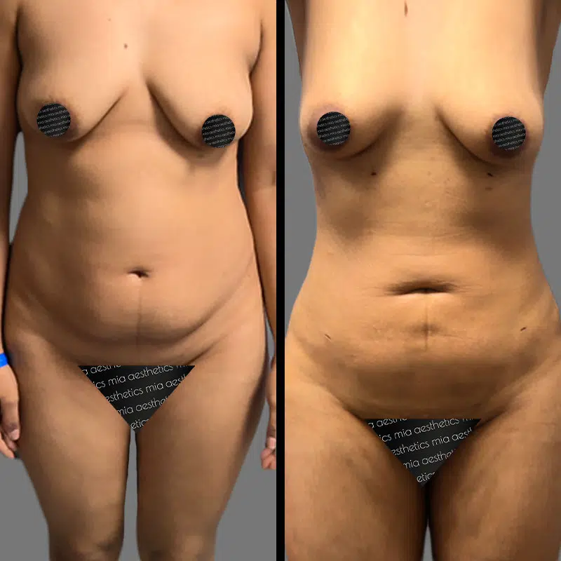 Dr. Rozentsvit Lipo 360 - Before & After 3