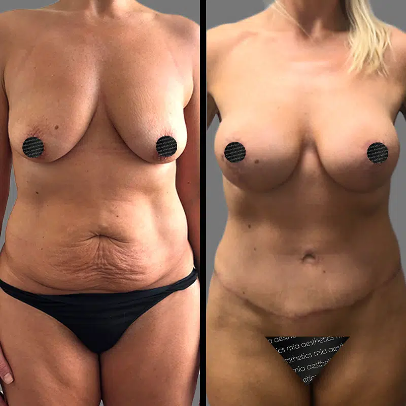 Dr. Rozentsvit Mommy Makeover - Before & After 1