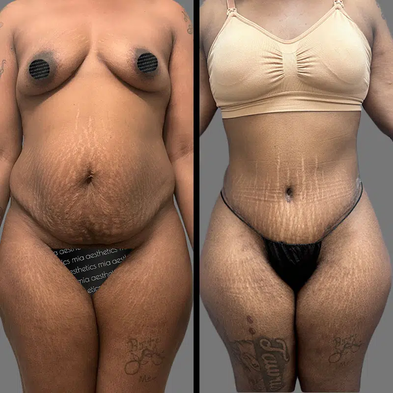 Dr. Rozentsvit Tummy Tuck - Before & After 2