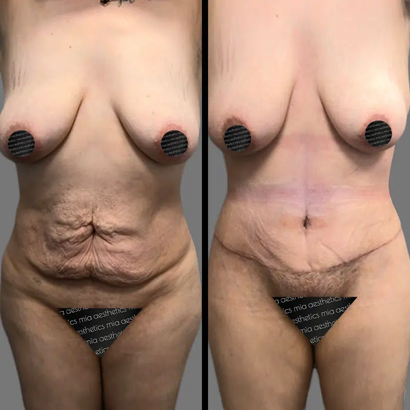 Dr. Rozentsvit Tummy Tuck - Before & After 3