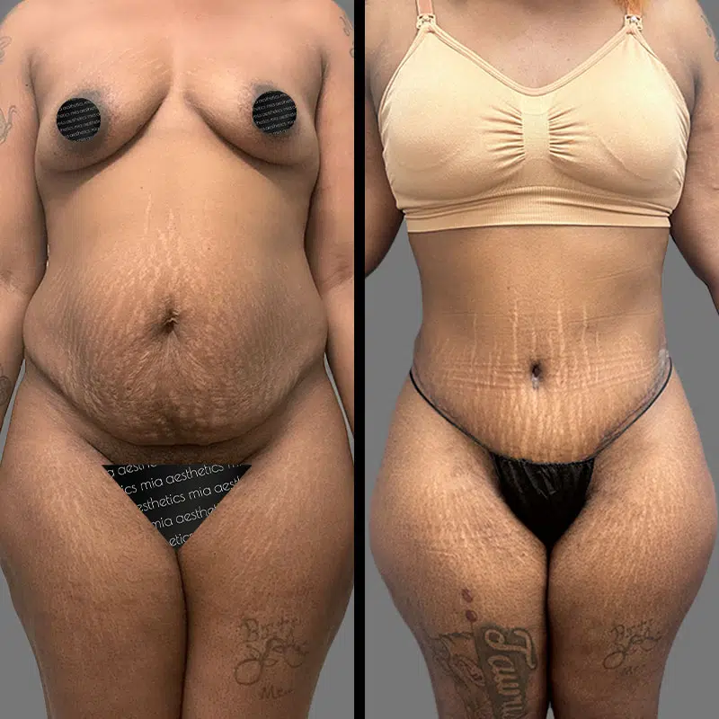 Dr. Rozentsvit Tummy Tuck - Before & After 4