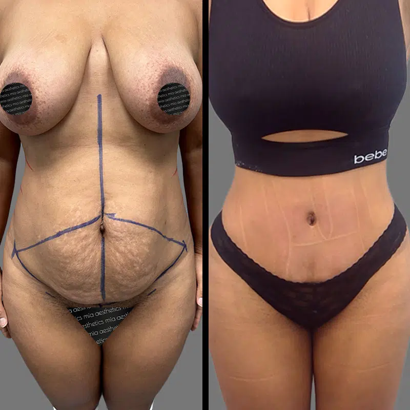 Dr. Sarcia Tummy Tuck - Before & After 4