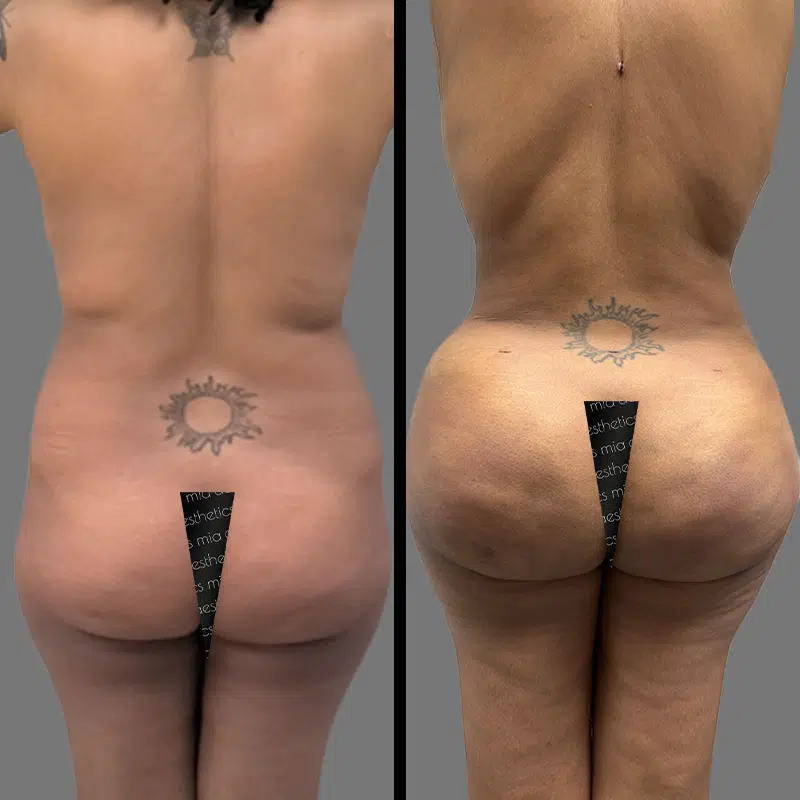 Dr. Scroggins BBL - Before & After 3