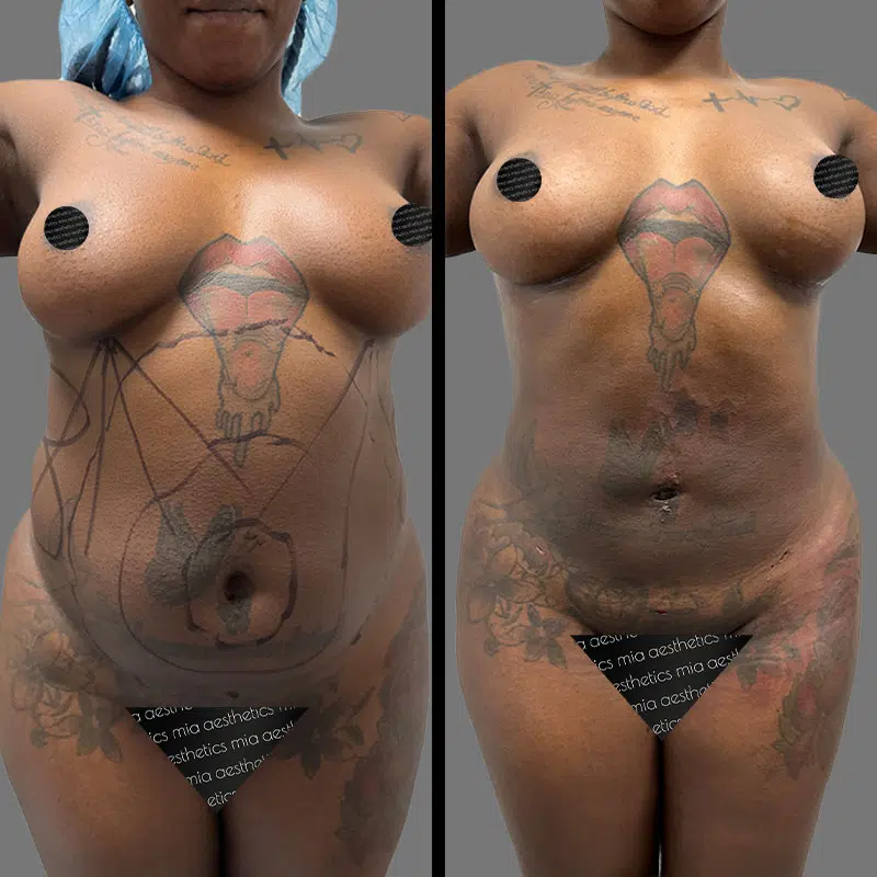 Dr. Scroggins Lipo 360 - Before & After 2