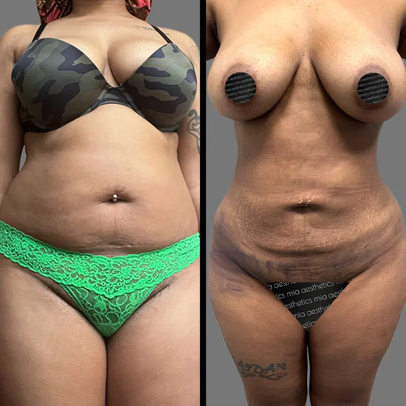 Dr. Scroggins Lipo 360 - Before & After 3