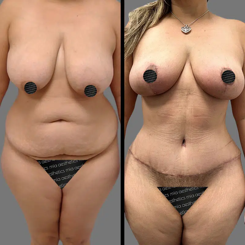 Dr. Scroggins Mommy Makeover - Before & After 1