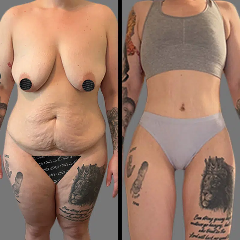 Dr. Scroggins Mommy Makeover - Before & After 2
