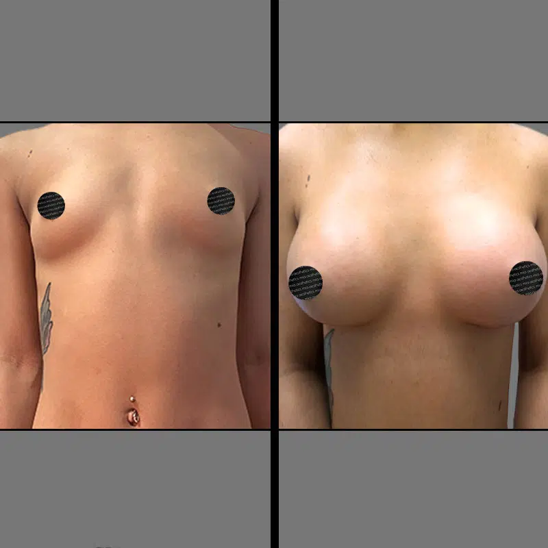 Dr. Towle Breast Augmentation - Before & After 1