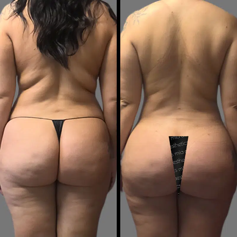 Dr. Valauri BBL - Before & After 3