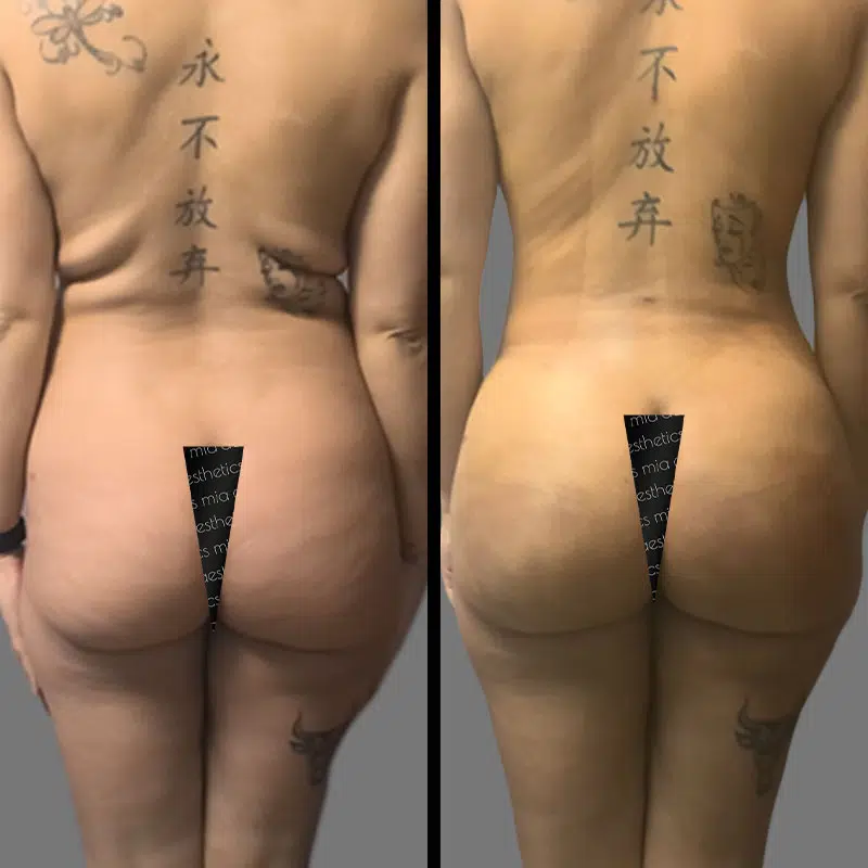 Dr. Valauri BBL - Before & After 4
