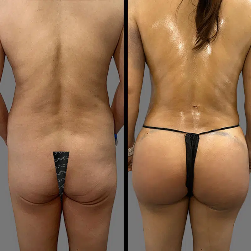 Dr. Wright BBL - Before & After 3