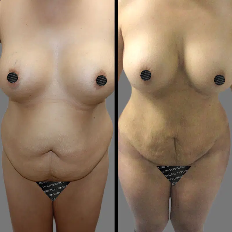 Dr. Wright Lipo 360 - Before & After 1