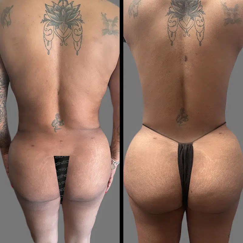 Dr. Bronstein BBL - Before & After 2