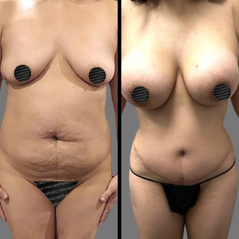 Dr. Bronstein Mommy Makeover - Before & After 1