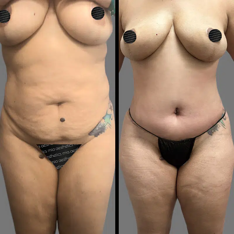 Dr. Bronstein Tummy Tuck - Before & After 2