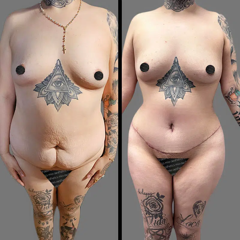 Dr. Bronstein Tummy Tuck - Before & After 3