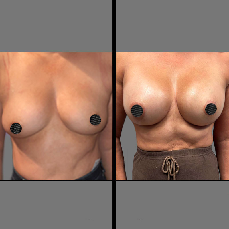 Dr. Charepoo Breast Procedure - Before & After 1