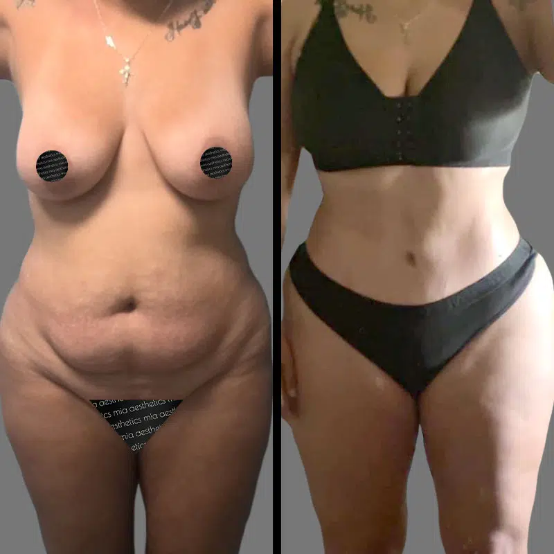 Dr. Cooper Tummy Tuck - Before & After 4