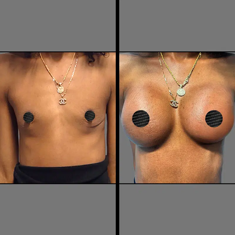 Dr. Elbayer Breast Augmentation - Before & After 5