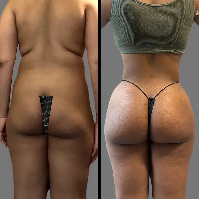Dr. Elbayer BBL - Before & After 5