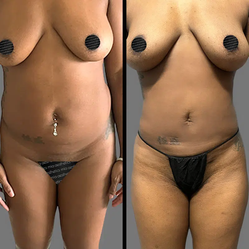 Dr. Elbayer Lipo 360 - Before & After 1