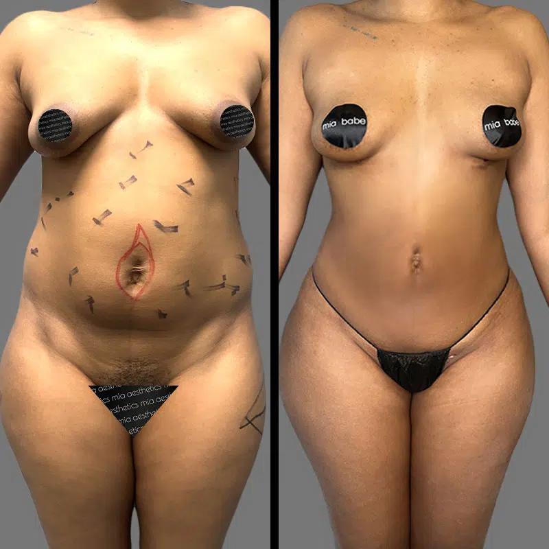 Dr. Elbayer Lipo 360 - Before & After 4