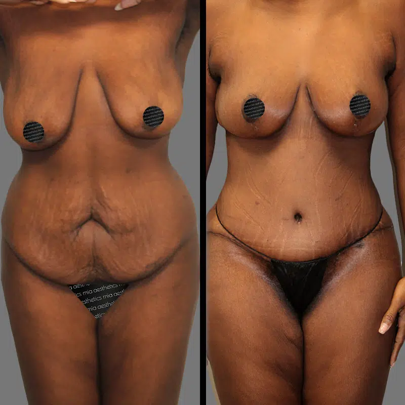 Dr. Sarcia Mommy Makeover - Before & After 3