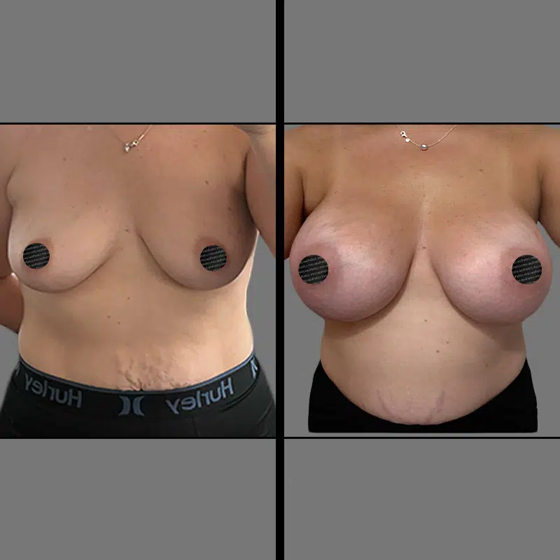 Dr. Scroggins Breast Augmentation & Lift - Before & After 4