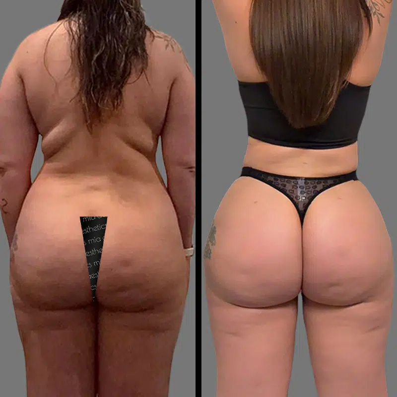 Dr. Valauri BBL - Before & After 4