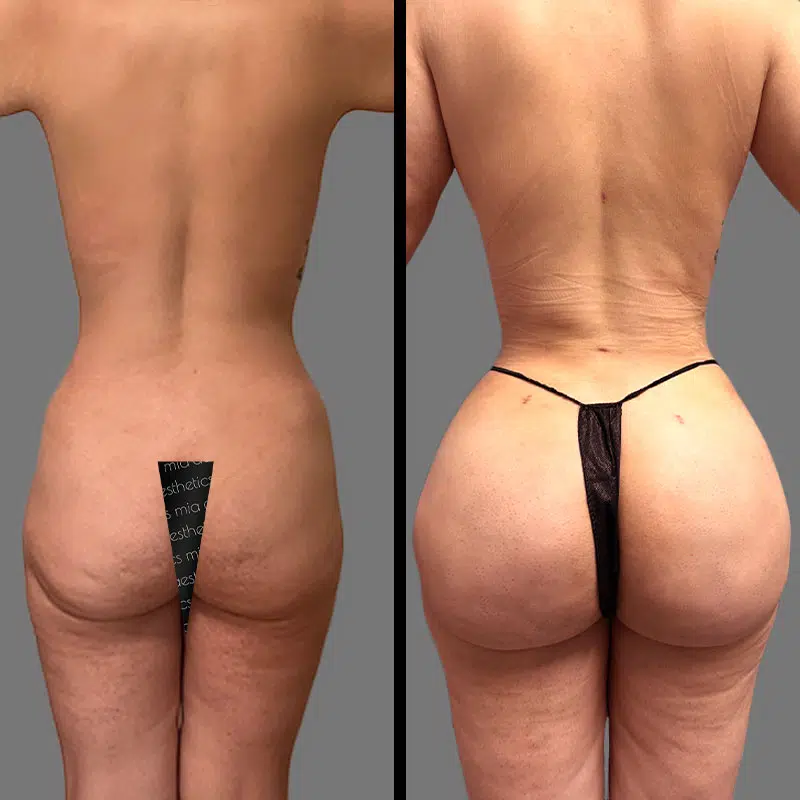 Dr. Elbayer BBL - Before & After 1