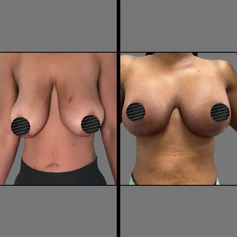 Dr. Giorgis Breast Augmentation & Lift - Before & After 4