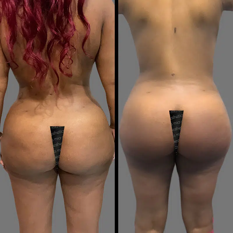 Dr. Giorgis BBL - Before & After 3