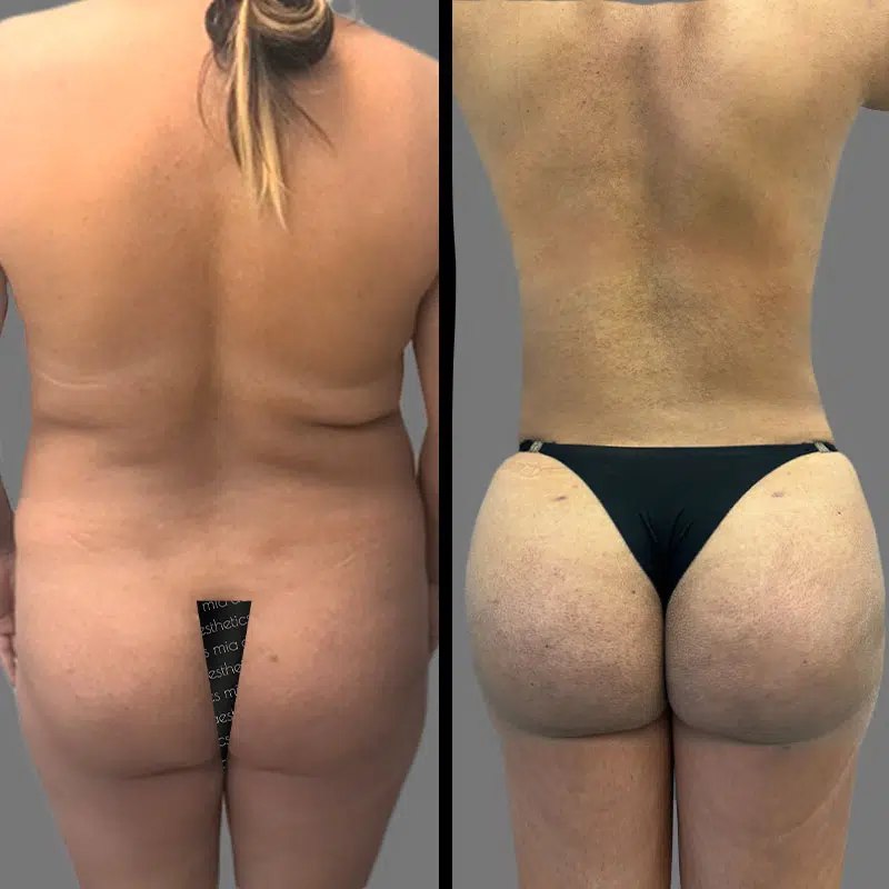Dr. Gray BBL - Before & After 1