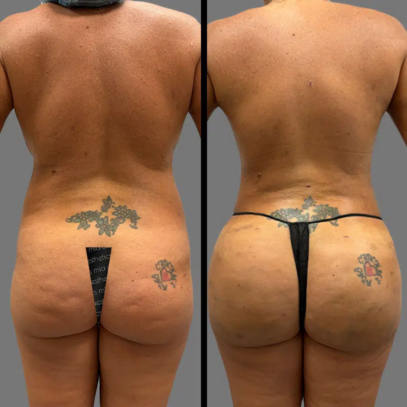 Dr. Gray BBL - Before & After 2