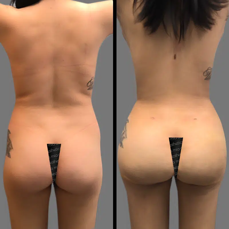 Dr. Gray BBL - Before & After 3