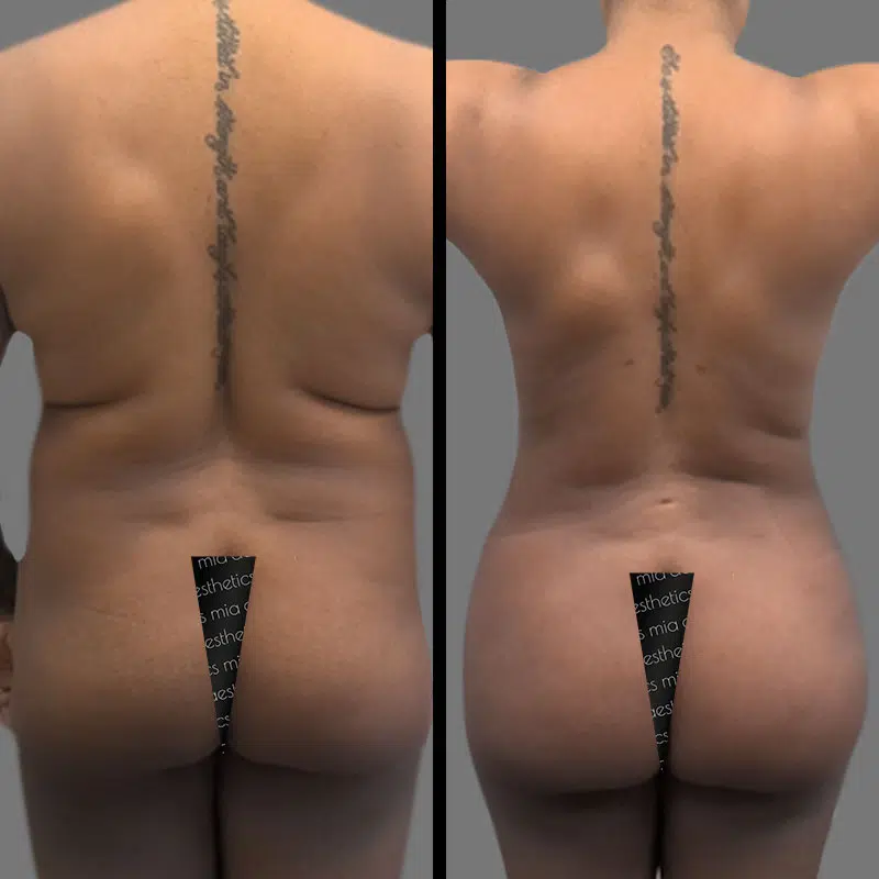 Dr. Gross BBL - Before & After 1