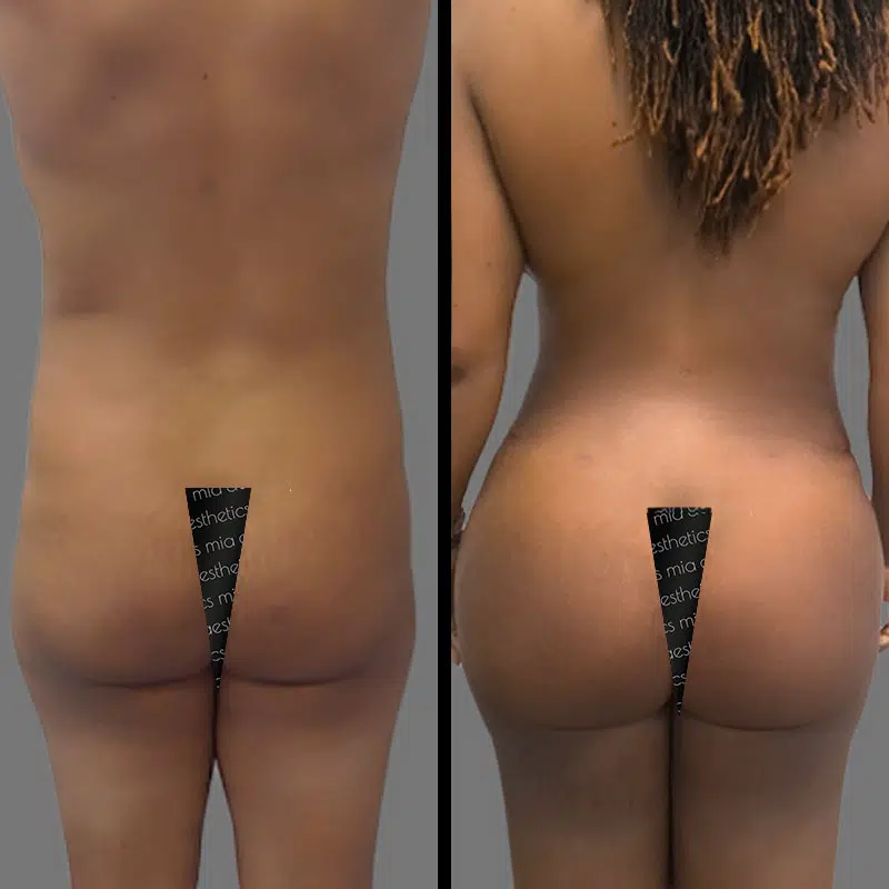 Dr. Gross BBL - Before & After 3