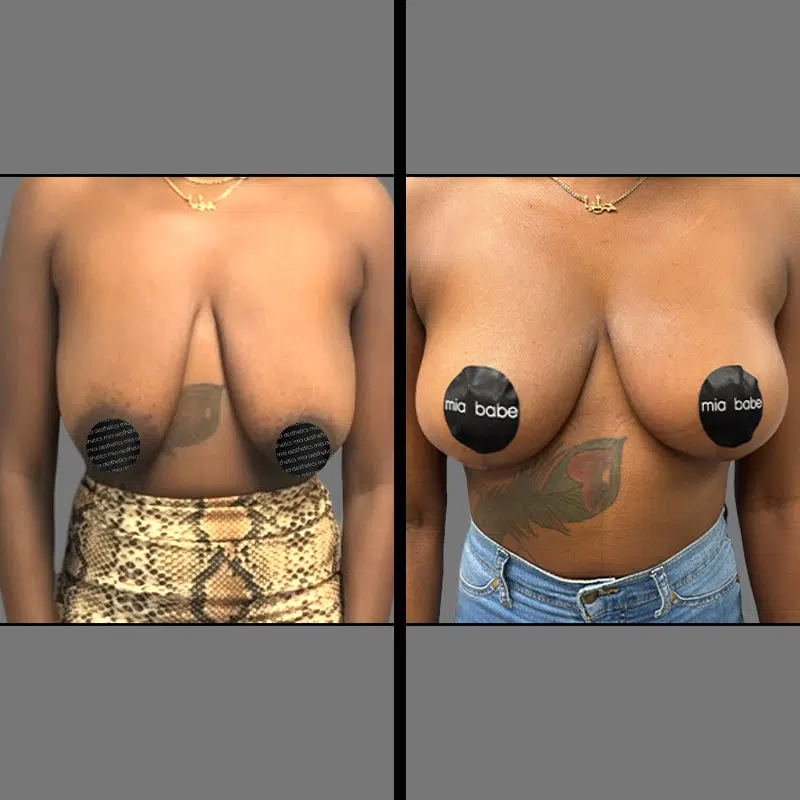 Dr. Gross Breast Lift - Before & After 2