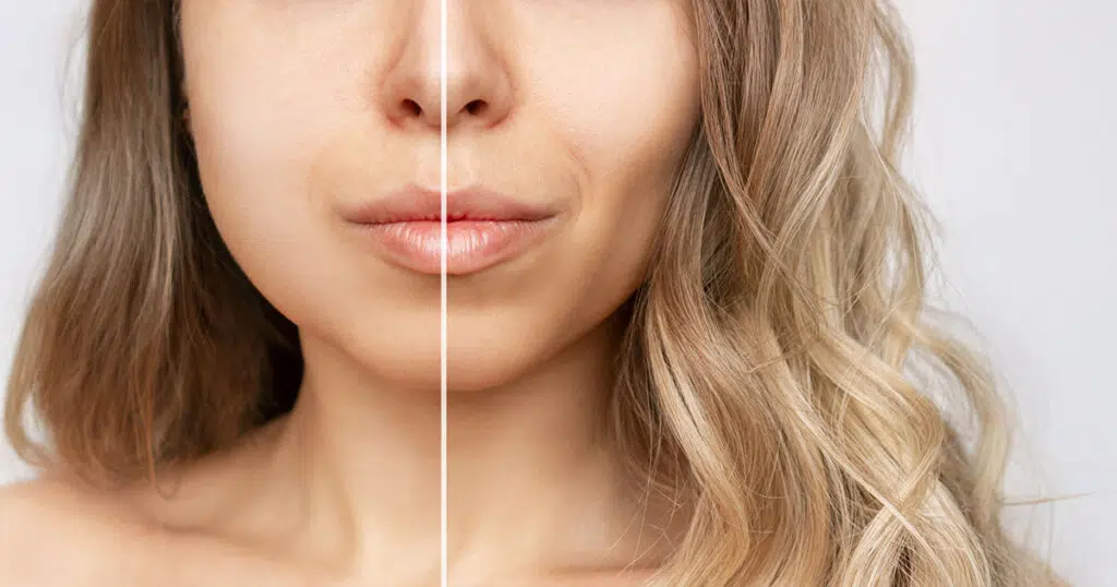 Young woman before and after buccal fat removal.