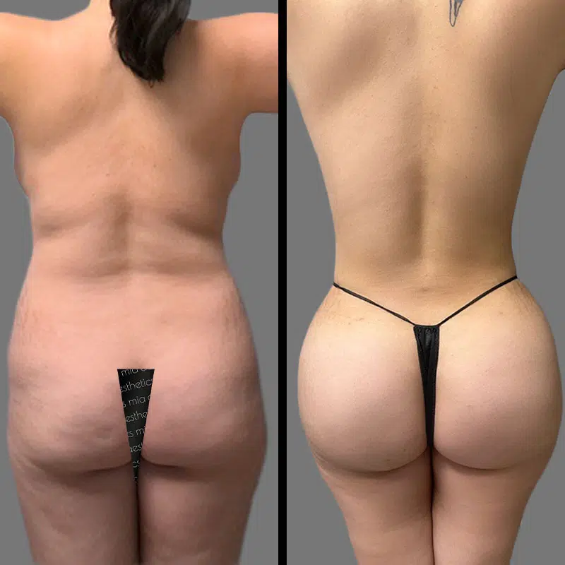 Dr. Hughes BBL - Before & After 1