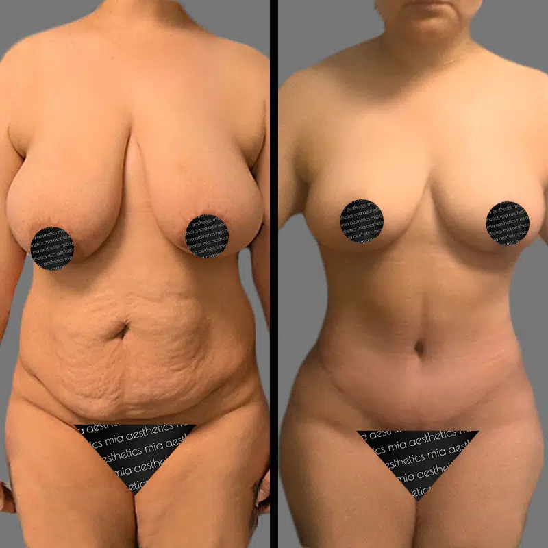 Dr. Hughes Mommy Makeover - Before & After 1