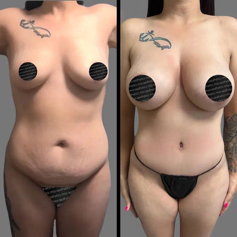 Dr. Hughes Mommy Makeover - Before & After 2