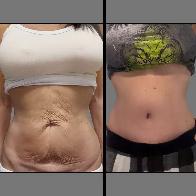 Dr. Schnarrs Tummy Tuck - Before & After 1