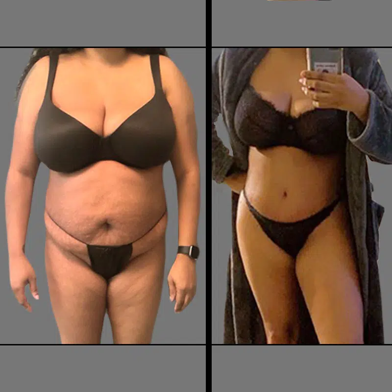 Dr. Schnarrs Tummy Tuck - Before & After 2