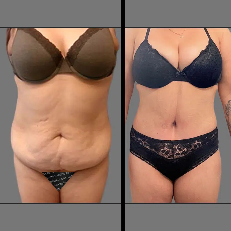 Dr. Schnarrs Tummy Tuck - Before & After 3