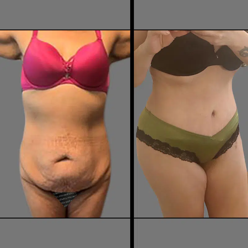 Dr. Schnarrs Tummy Tuck - Before & After 4