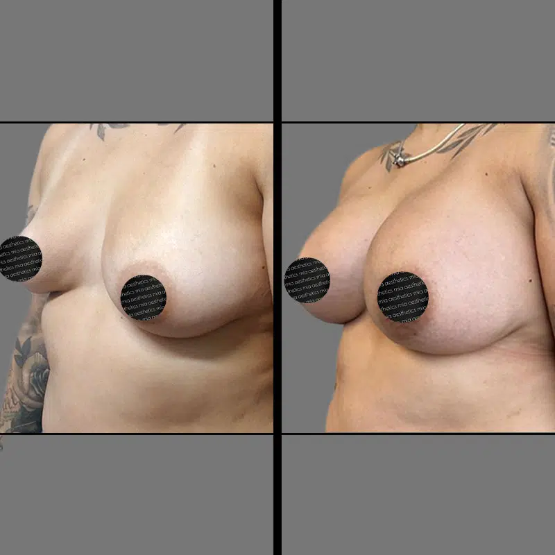 Dr. Penukonda Breast Procedure - Before & After 1