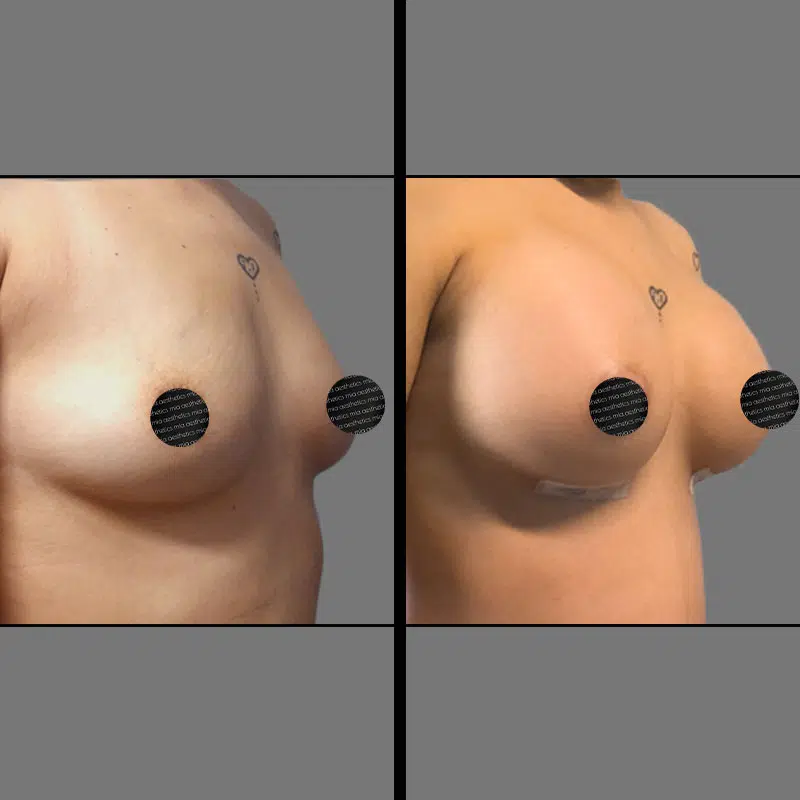 Dr. Penukonda Breast Procedure - Before & After 2