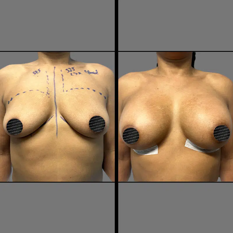 Dr. Penukonda Breast Procedure - Before & After 3